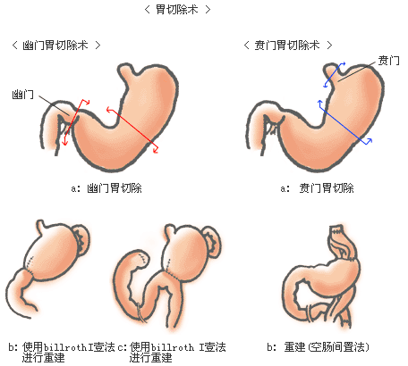 胃肿瘤切除手术方法图