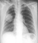 肺肿瘤图片
