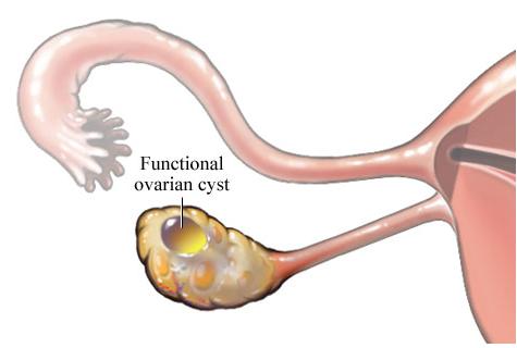卵巢肿瘤图片