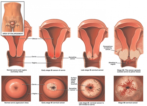 宫颈肿瘤图片