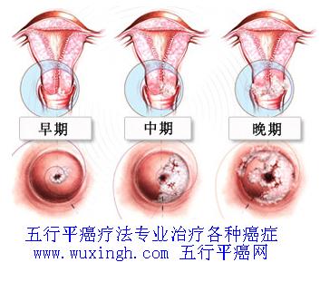 宫颈肿瘤早期图,宫颈肿瘤中晚期图片