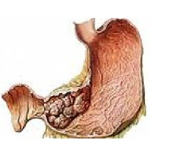 胃肿瘤晚期症状图